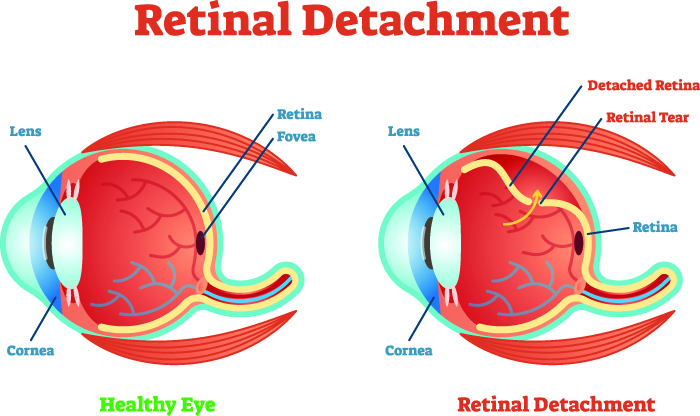 Retina Detachment