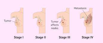 What are the different stages of breast cancer?