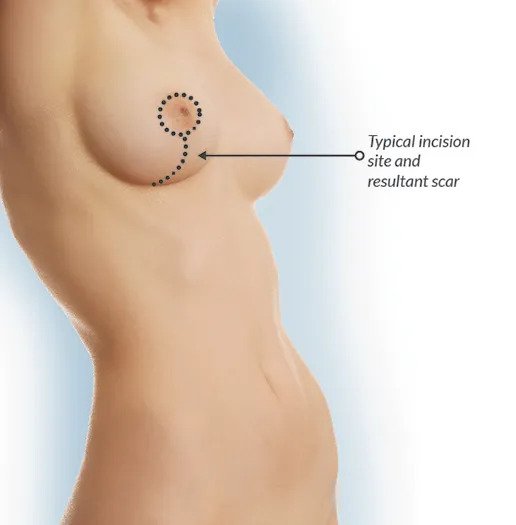 Can a breast lift be combined with other procedures?