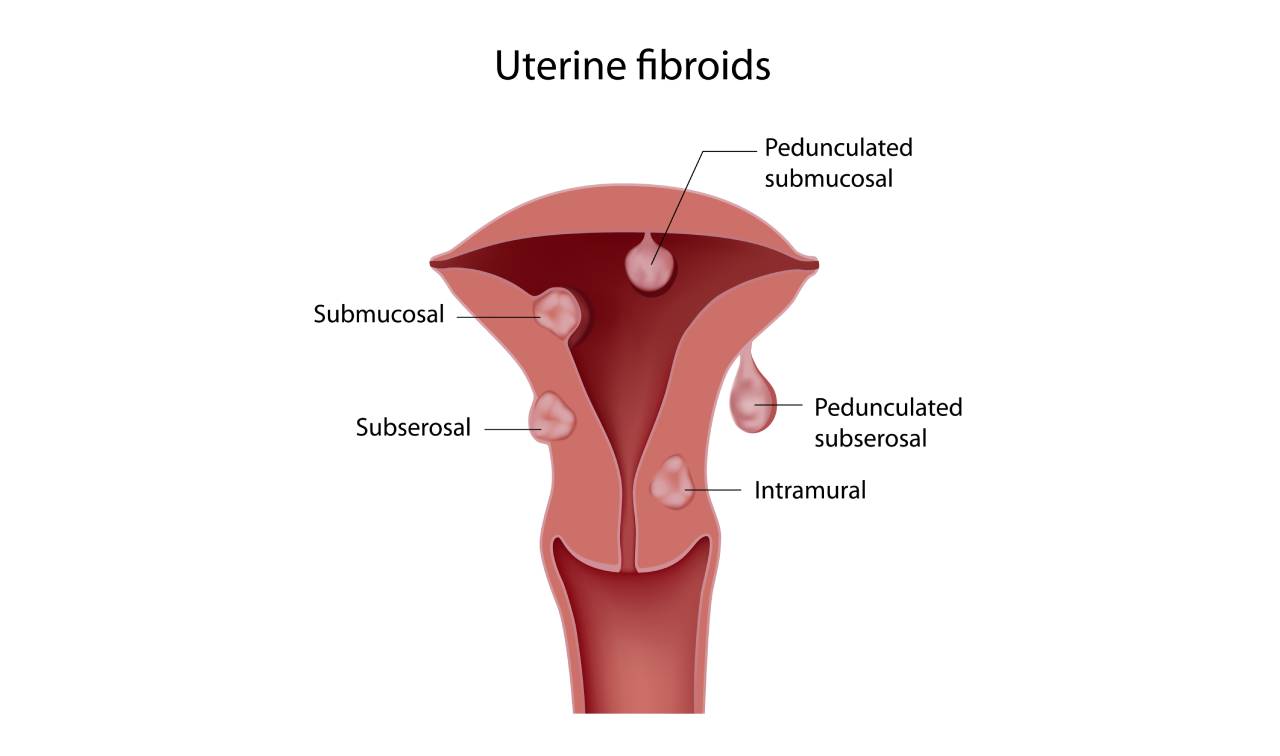 How can I maintain my overall gynecological health and prevent future fibroid growth?