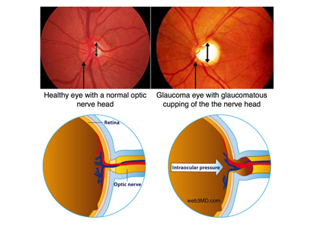 Glaucoma Treatment