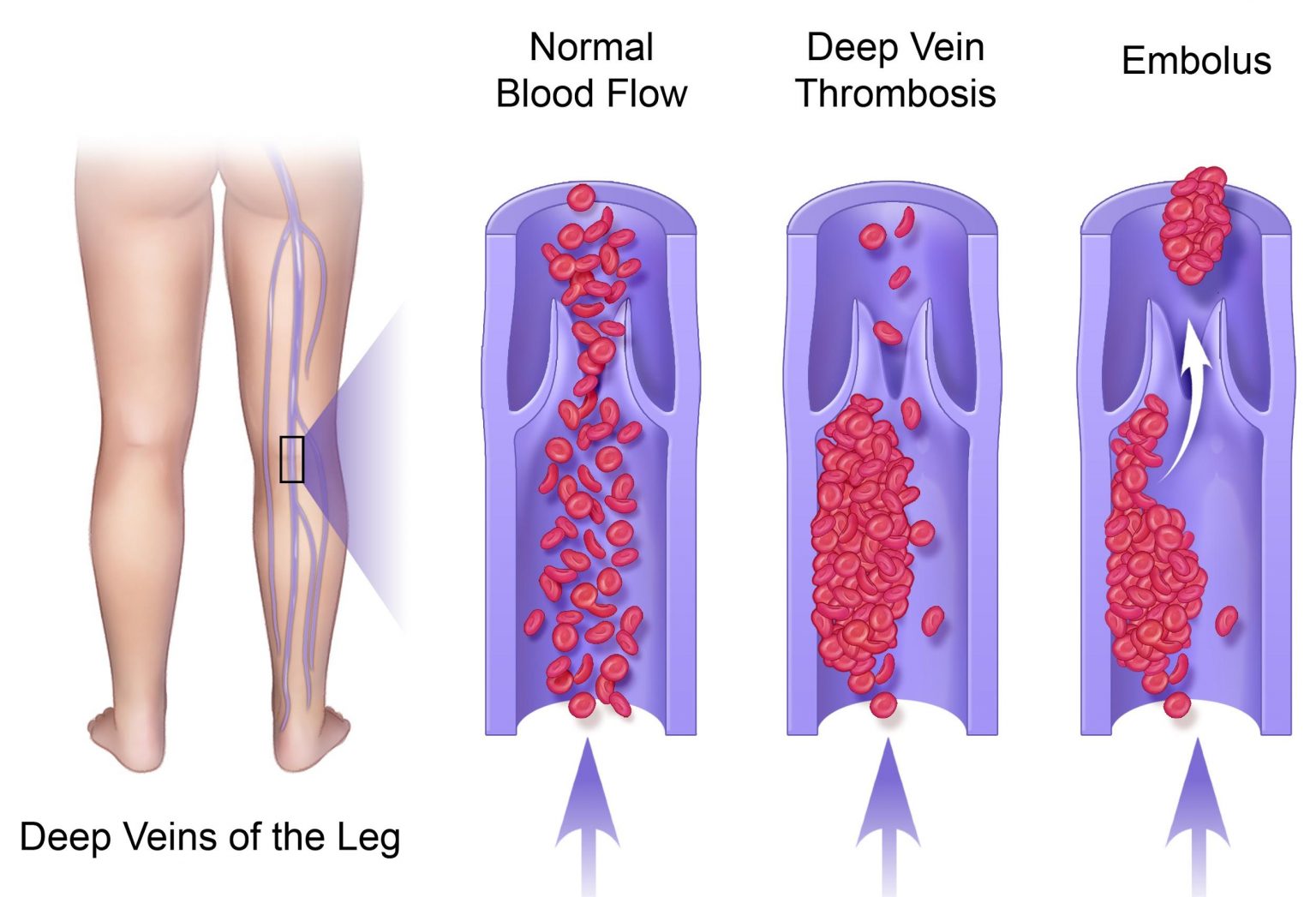 Is DVT more common in certain demographics or age groups?