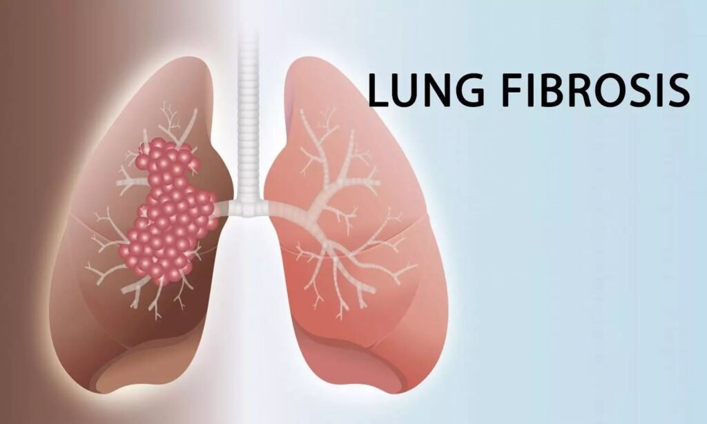 What are the common symptoms of lung fibrosis? Doctor Near Me
