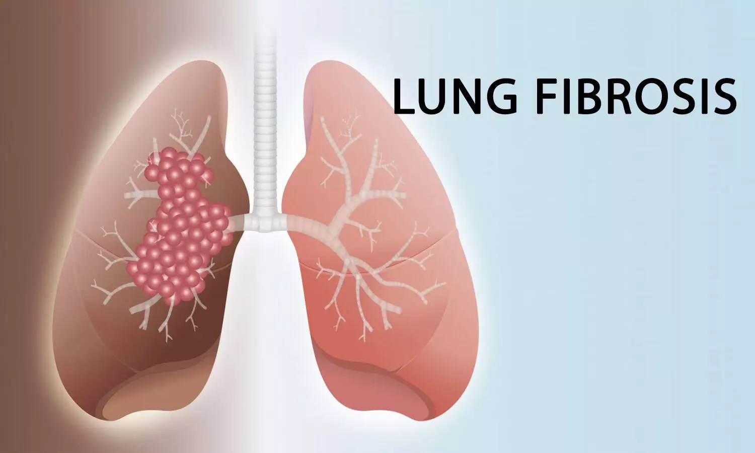 What are the common symptoms of lung fibrosis?