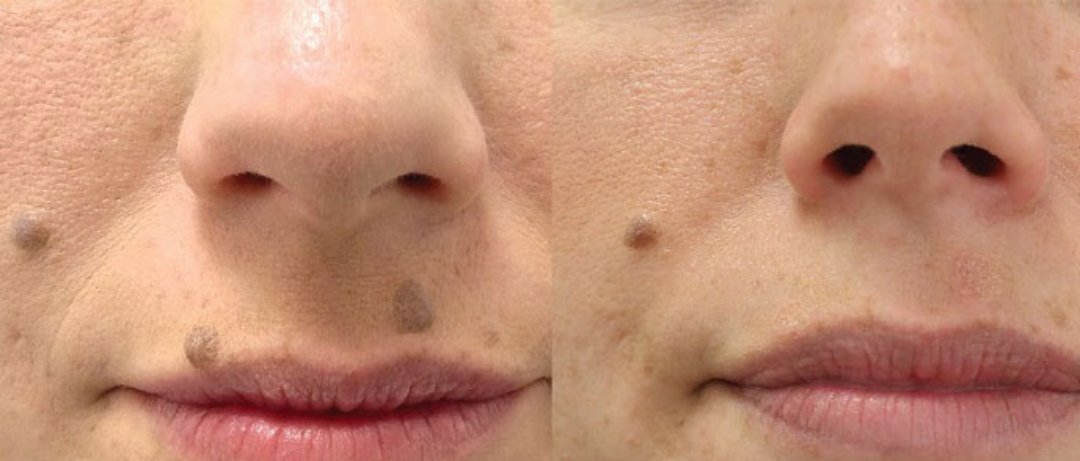 Is mole removal a permanent solution, or can moles grow back?