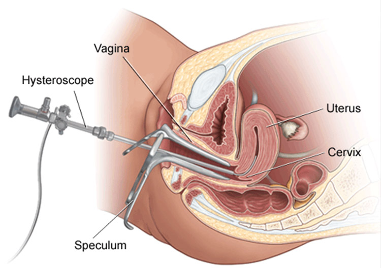 Does a hysteroscopic polypectomy affect the likelihood of a multiple pregnancy ?