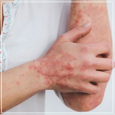 psoriaris Treatment