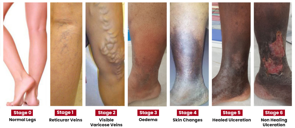 Varicose Vein Treatment in Mumbai