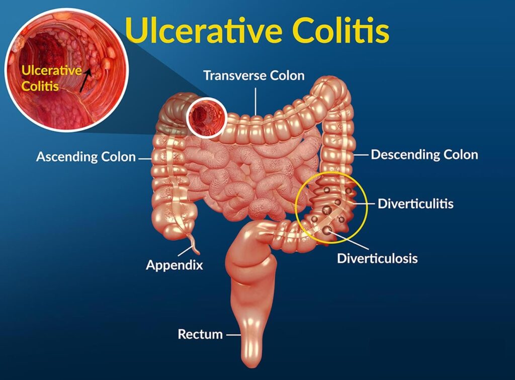 What are the common symptoms of ulcerative colitis?