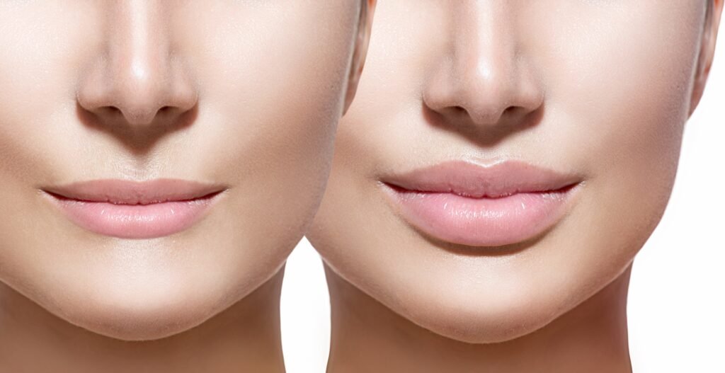 What are lip fillers? Doctor Near Me