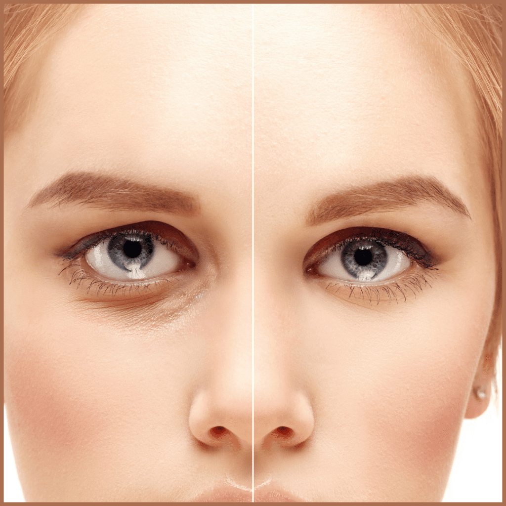 Who is a good candidate for blepharoplasty? Doctor Near Me
