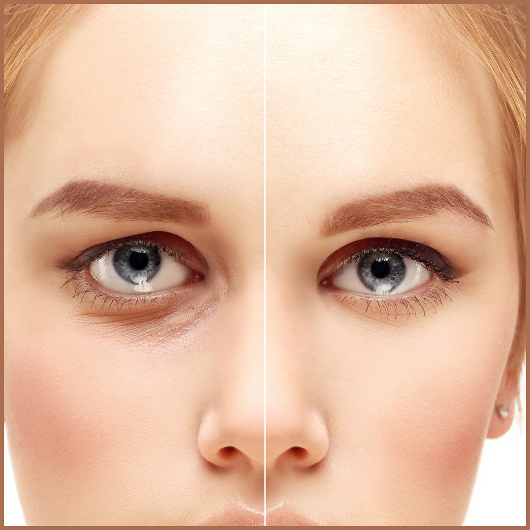 Who is a good candidate for blepharoplasty?