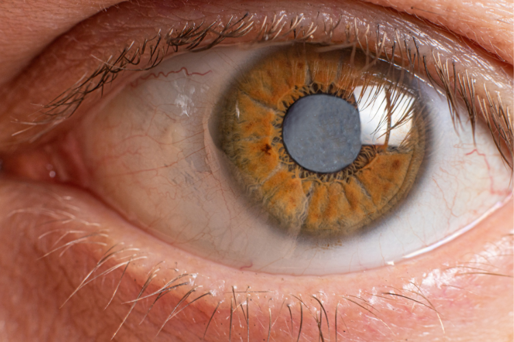 Can I have cataract surgery in both eyes on the same day?