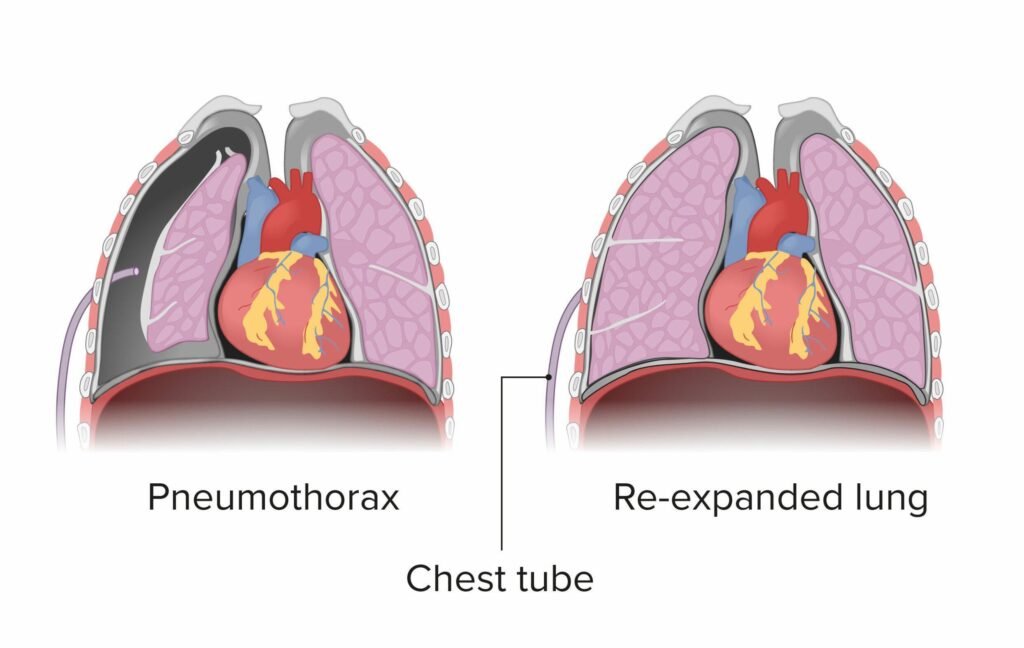 Can a patient move with a chest tube in place? Doctor Near Me