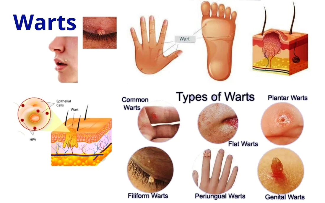 What are the types of warts?