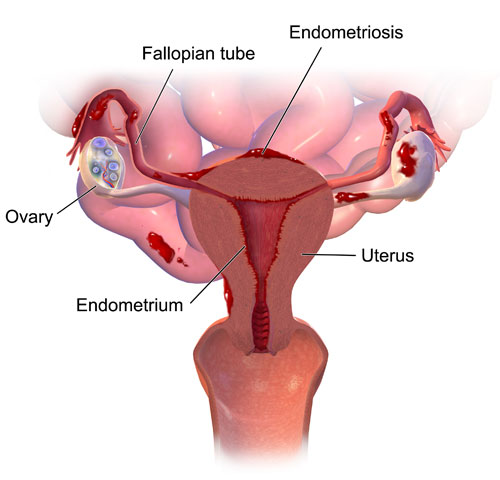 Can endometriosis return after treatment or surgery?