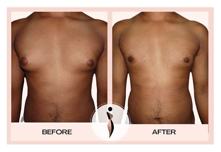 What are the potential benefits of gynecomastia surgery?