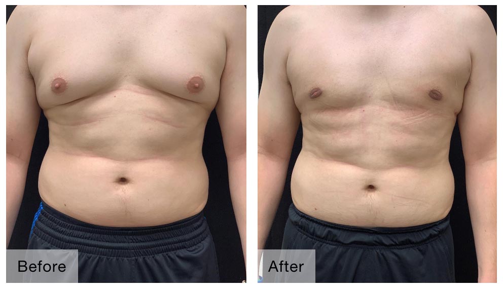 When can I resume normal activities after gynecomastia surgery?