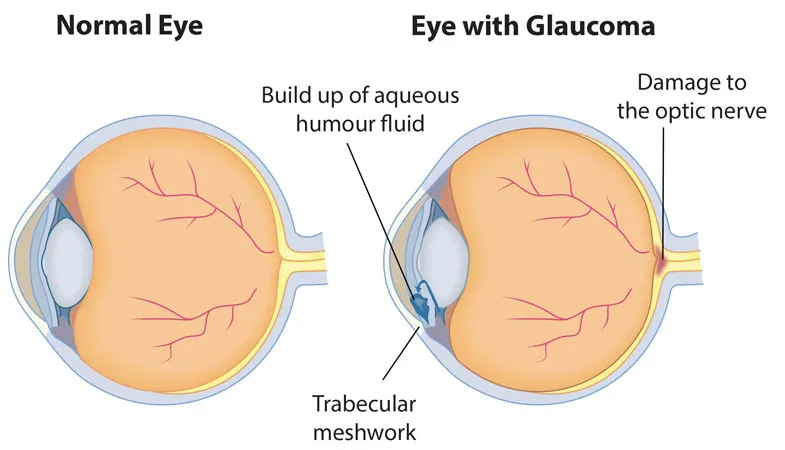 How does glaucoma affect quality of life?