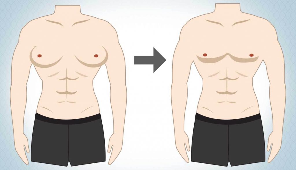 Can gynecomastia recur after surgery?