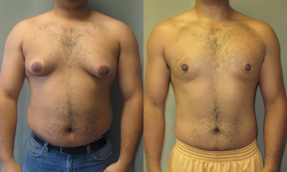 Why consider getting treatment for gynecomastia?