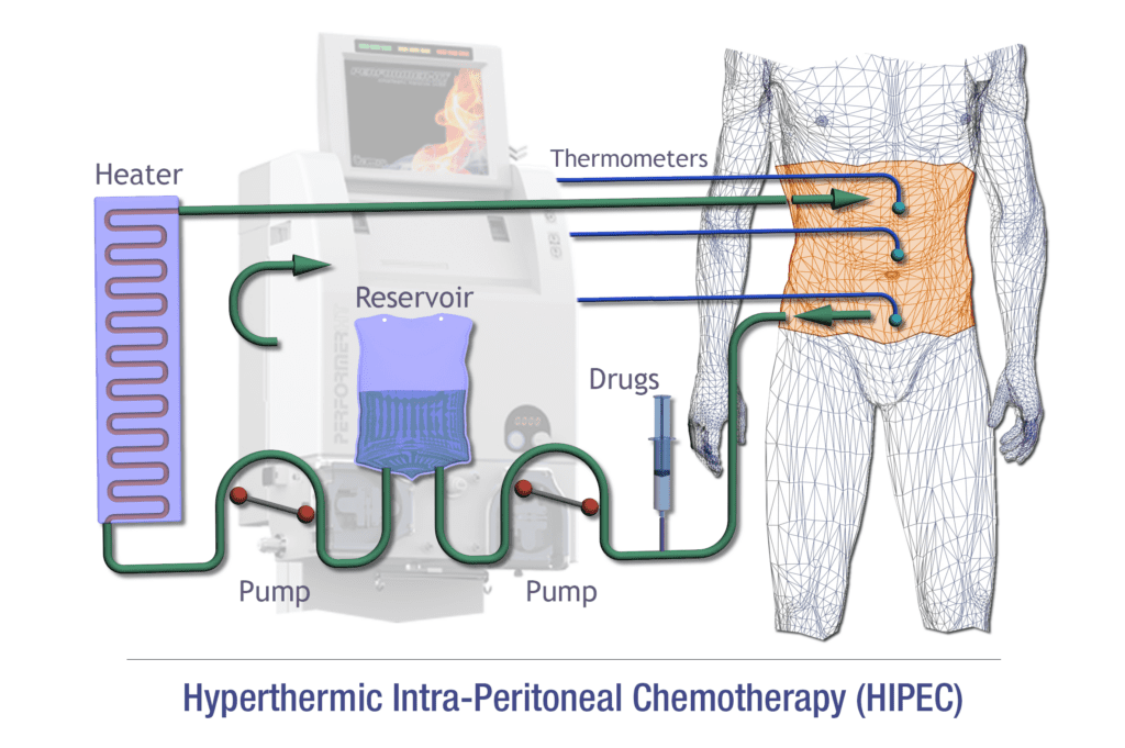 What are the potential benefits of HIPEC? Doctor Near Me