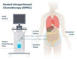 What Imaging or Diagnostic Tests are Used to Determine Eligibility for HIPEC?