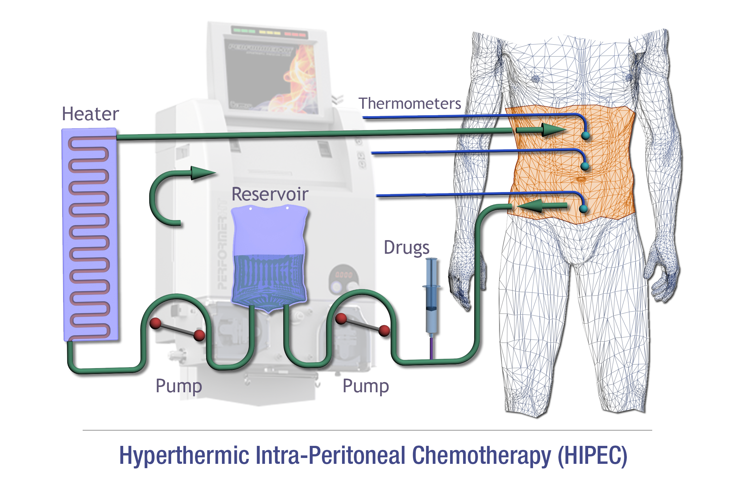 What are the potential benefits of HIPEC?