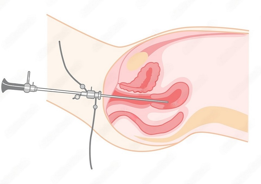 How is pre-IVF hysteroscopy performed?