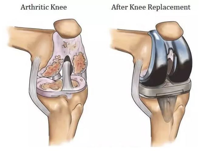 When is Knee Replacement Surgery Recommended?