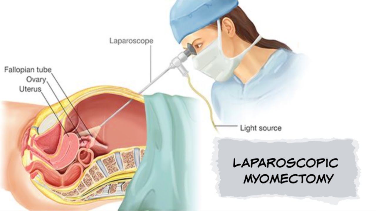 Will laparoscopic myomectomy affect fertility?