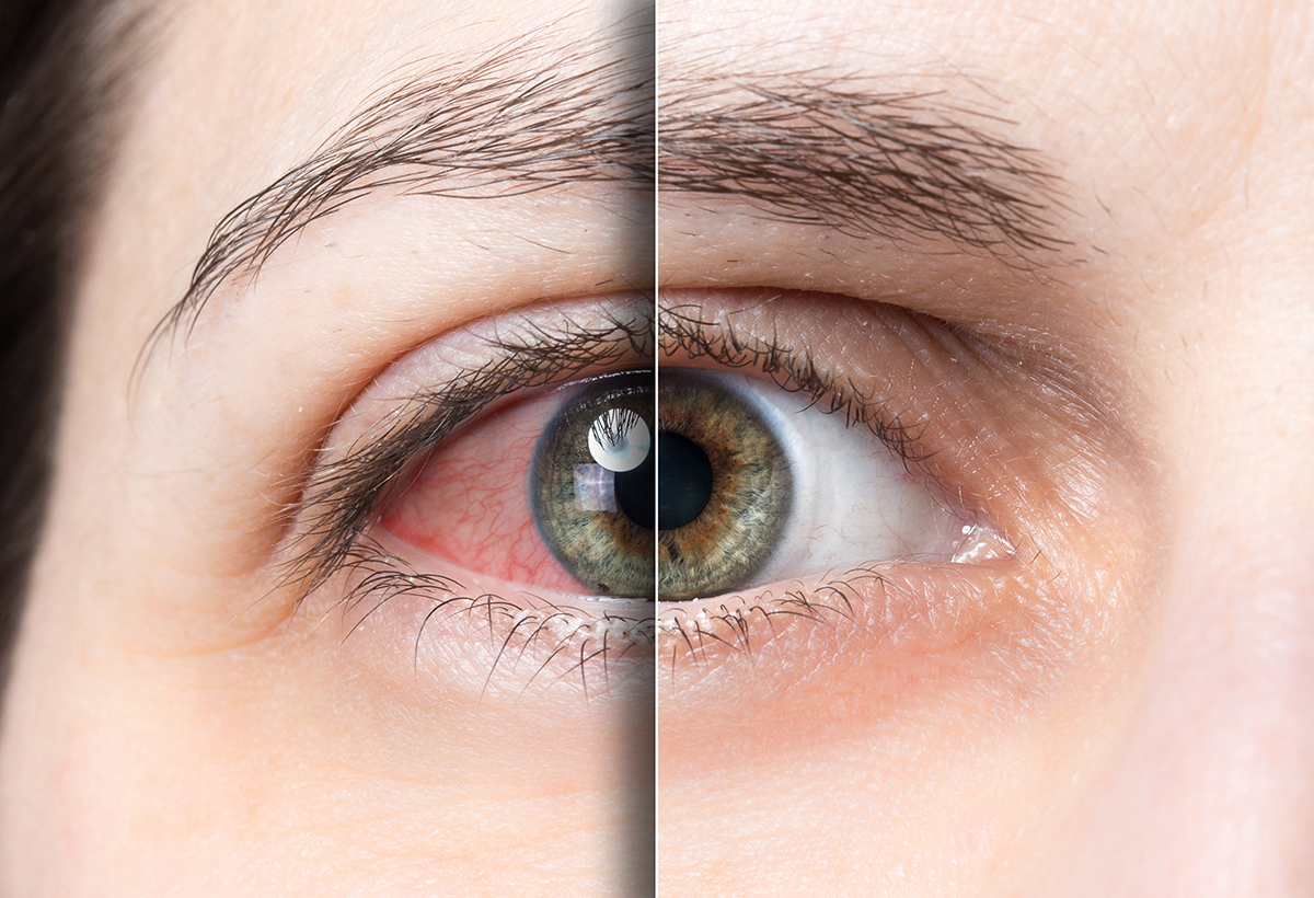 Can you get LASIK if you have dry eyes?