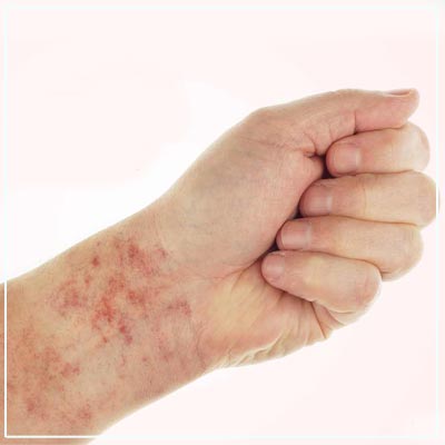 What causes lichen planus?