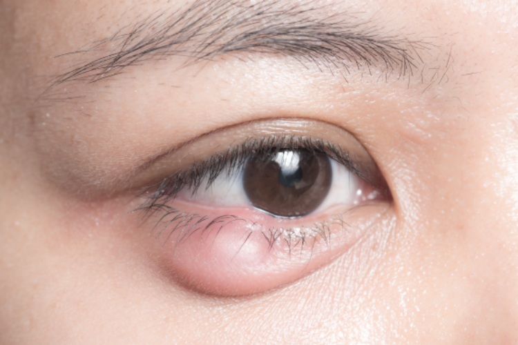 When should I see an oculoplasty specialist?