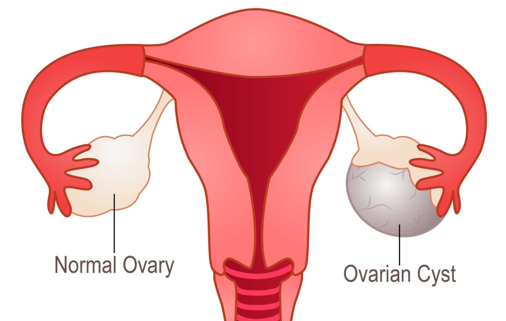 What are the common symptoms of ovarian cysts that may require cystectomy?