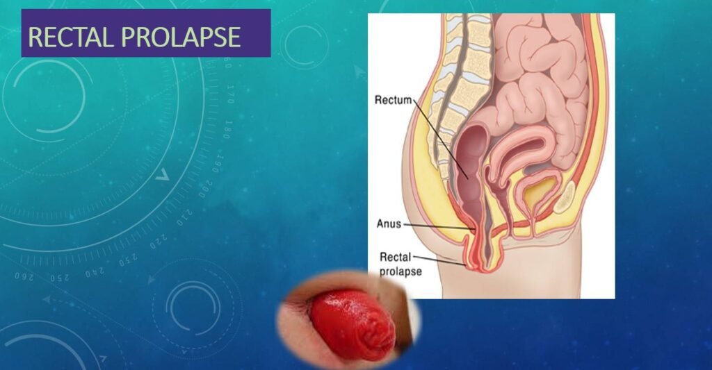 Can rectal prolapse occur in children? Doctor Near Me