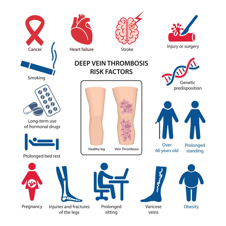 What are the risk factors of DVT ?