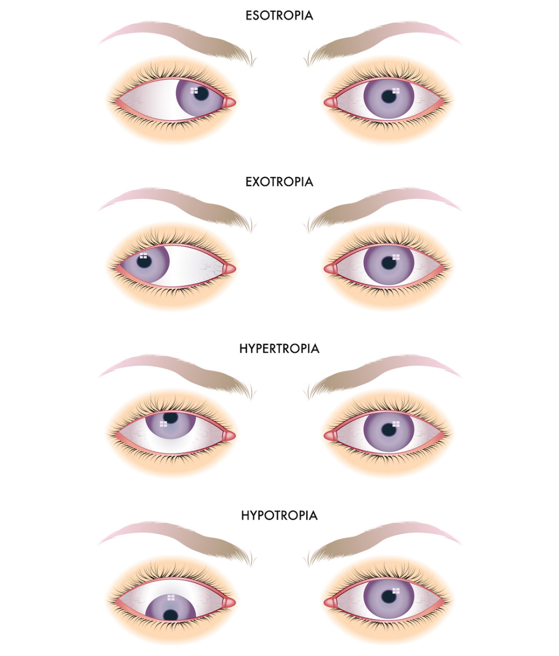 What causes a squint eye, and can it develop at any age?