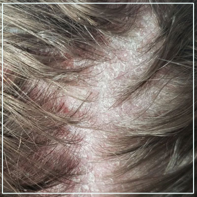 How is Seborrheic Dermatitis Diagnosed?