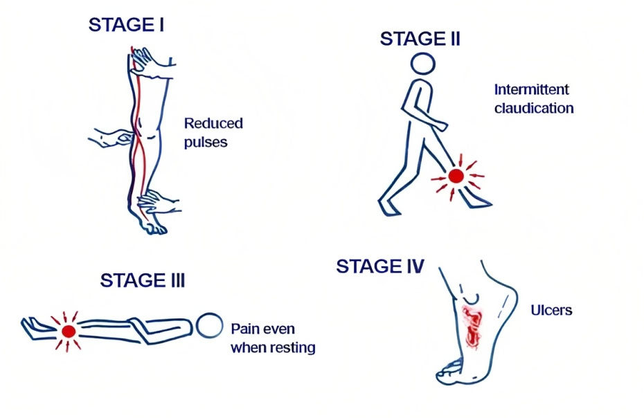 What are the stages of peripheral vascular disease?