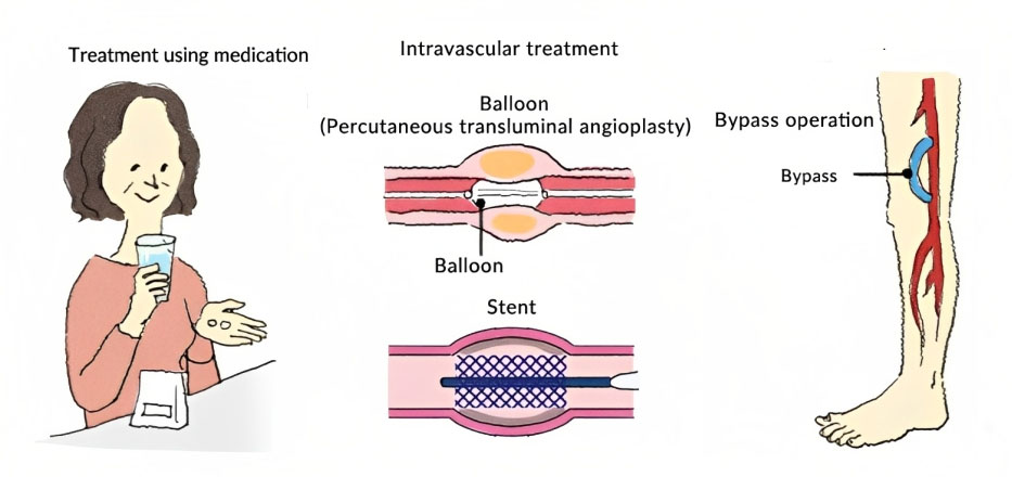 How can peripheral arterial disease be treated ?