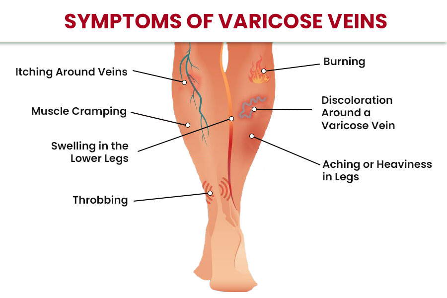 What are the symptoms of varicose veins?