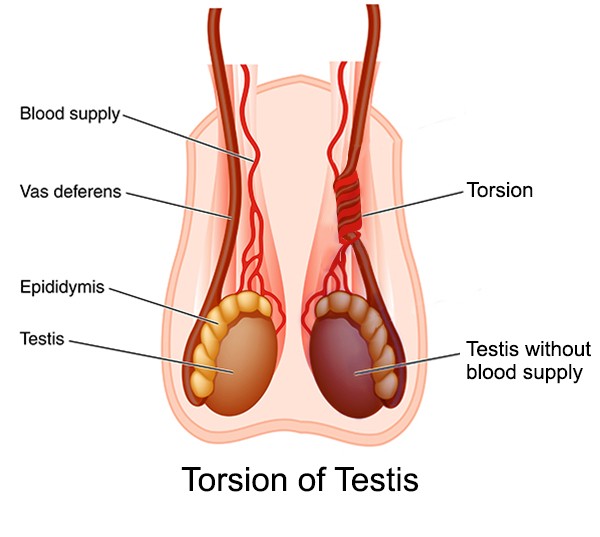 What are the symptoms of testicular torsion?