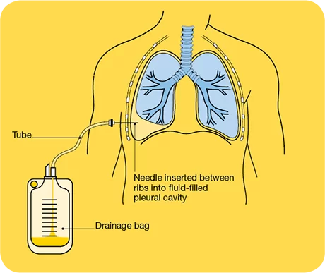 Why is thoracentesis performed?