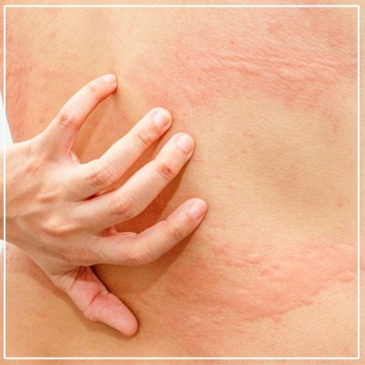 Can certain foods trigger urticaria?