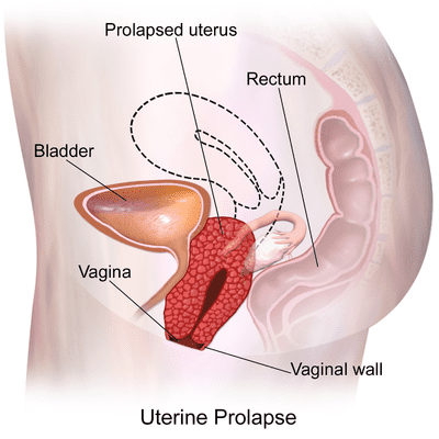 What are the common symptoms of uterine prolapse?