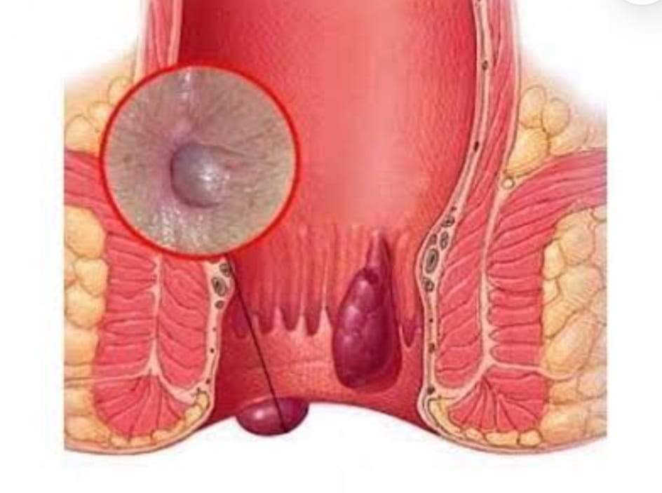 What are the symptoms of anal fissures, and how are they diagnosed?