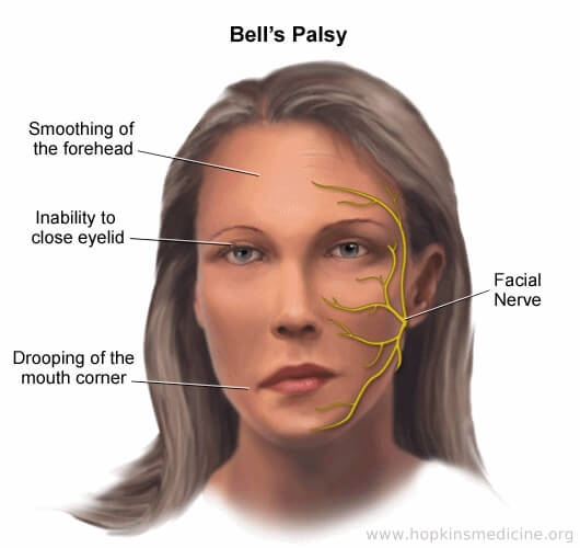 How is Bell’s Palsy Diagnosed?