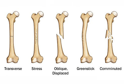 Can you explain the process of bone remodeling after a fracture heals?