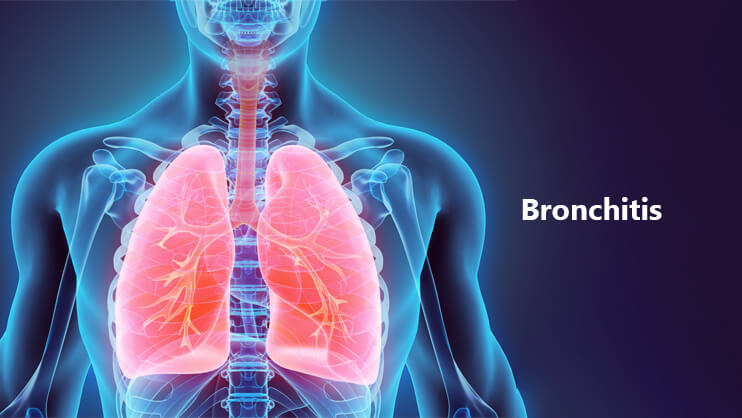 What causes bronchitis?